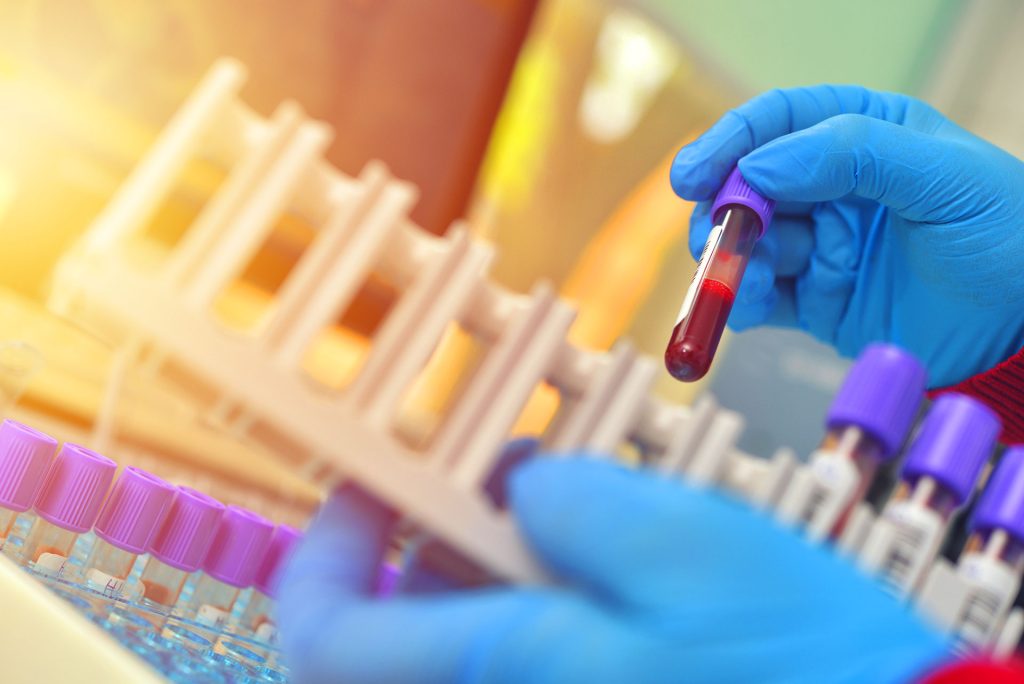 What Your Blood Test Isn’t Telling You (And Why ApoB Might Be the Missing Link)