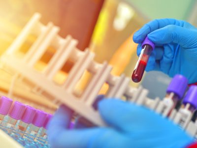 What Your Blood Test Isn’t Telling You (And Why ApoB Might Be the Missing Link)